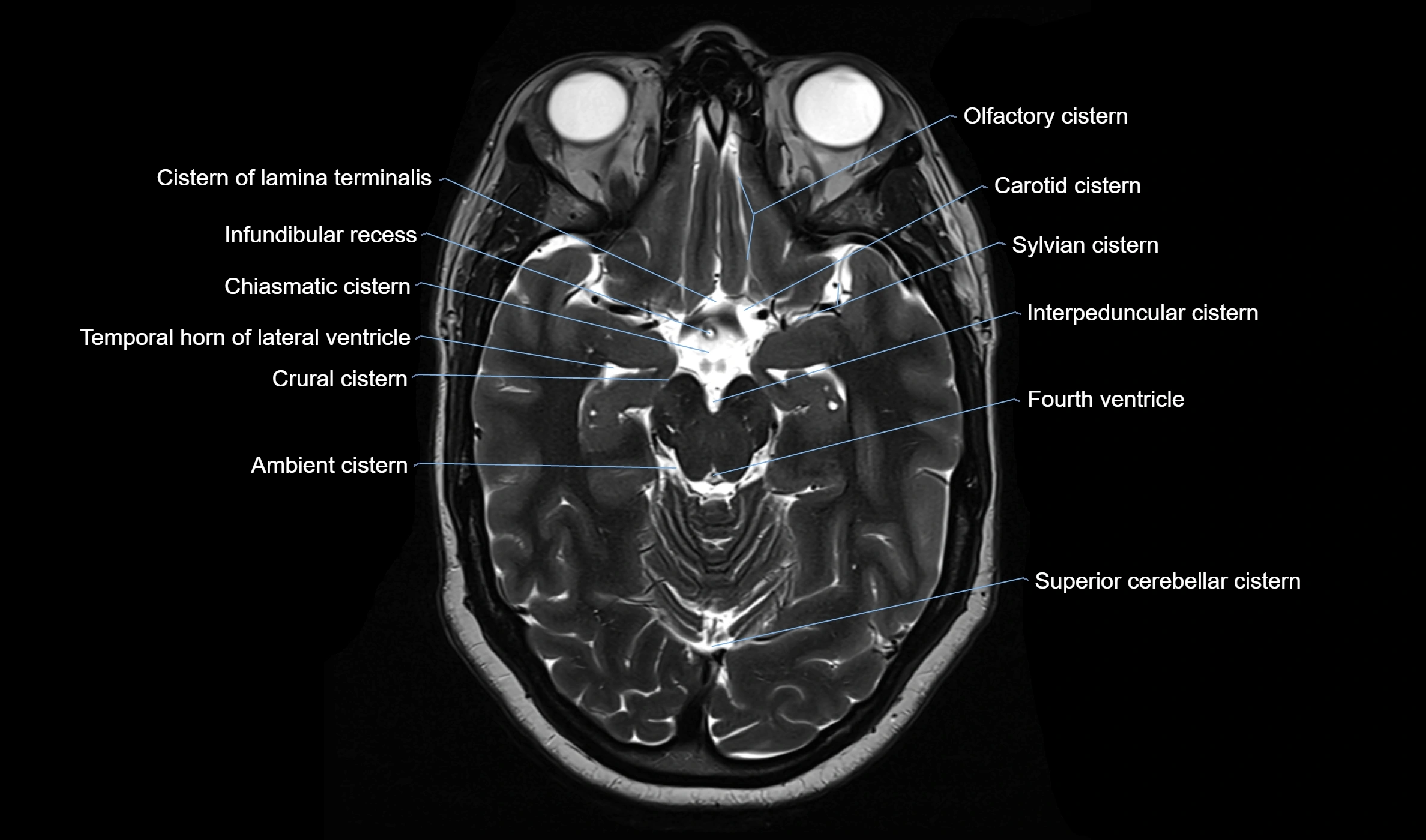 Brain cisterns  and ventricles  axial anatomy 3T MRI image-img-00001-00021.webp
